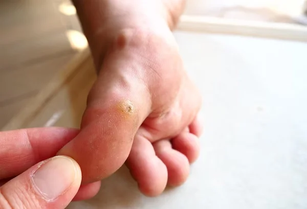 Verruacae