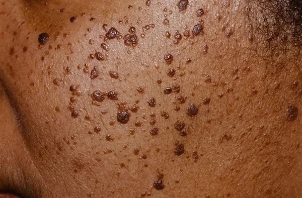 Dermatosa Papulosa Nigra